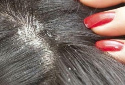 吃小瓜后头皮痒